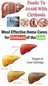 12 Home Remedies For Cirrhosis Of The Liver | Fatty Liver Remedies, Liver  Diet, Fatty Liver Treatment