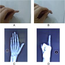 114 downloads 446 views 114kb size. Scar Overlapping Suture For Treating Chronic Tendinous Mallet Finger In Children Journal Of Orthopaedic Surgery And Research Full Text