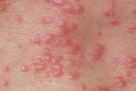 Home » skin health » how to get rid of hives naturally? Scabies Nhs