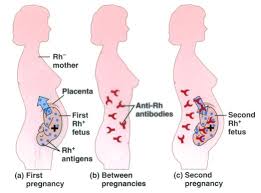 Image result for Rh Sensitization