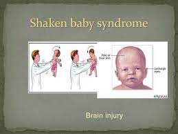 Shaken Baby Syndrome