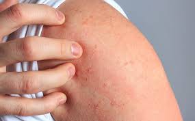 Image result for Hives