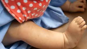 Since many laboratories use instruments that. Pediatric Hematology Thrombocytopenia In Newborns Thrombocytopenia In Newborns Introduction Diseases And Conditions Pediatric Oncall