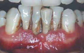 What are gingivitis and periodontitis? Periodontitis Cronica Chronic Periodontitis Download Scientific Diagram