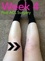 Post Acl Surgery Week 4 Acl Surgery Acl Surgery Recovery Acl