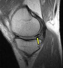 What do i do after my scan? What Is Magnetic Resonance Imaging Mri Of The Knee