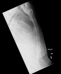 Image result for Sternal Fracture