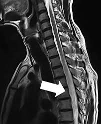 Image result for Myelitis