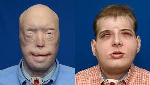 Disfigured Fireman Given New Lease of Life Following World's Most Extensive  Face Transplant