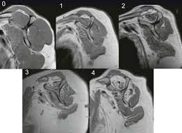 Image result for Rotator Cuff Rupture