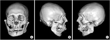Image result for Jaw Dislocation