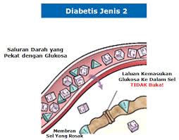 Dengarkan perkongsian menarik bersama pakar perunding sakit dalaman, dr. Punca Sebenar Kencing Manis Type 2 Rintangan Insulin