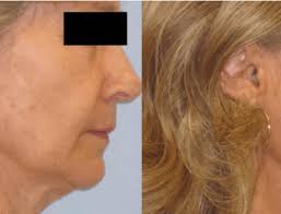 Does Ultherapy Have Any Side Effects Long Beach Ultherapy Laser Skin Care Center