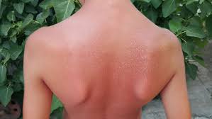Image result for Sunburn