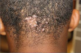 Image result for folliculitis symptoms