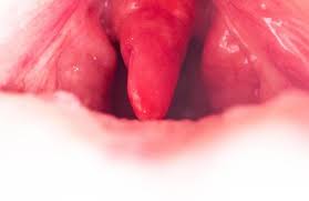 Image result for Uvulitis
