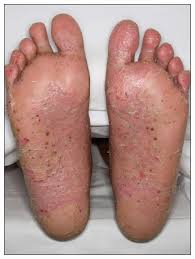 Image result for Pustular Psoriasis