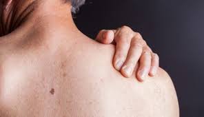 One in seven men in the united states will receive a prostate cancer diagnosis during his lifetime. Cancer Treatment Side Effect Skin Changes Md Anderson Cancer Center