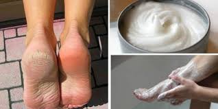 Calos Nos Pés Olho De Peixe Descubra Como Preparar Um Poderoso Remedio Caseiro Para Eliminar Fungos E Calos Dos Pes Veja Como Deixar Seus Pes Muit Treat Psoriasis Foot Callus Foot Fungus
