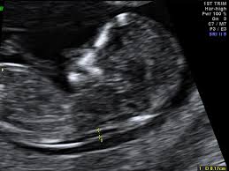 I recently had my nt scan, which i only got because i have multiple losses at 10 and 10.5 weeks. Pregnancy Prenatal Care From Newcastle Ultrasound