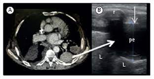Ultrasound guidance decreases complications and improves the cost of care among patients undergoing thoracentesis and. Scielo Brasil Lung Ultrasound In The Evaluation Of Pleural Effusion Lung Ultrasound In The Evaluation Of Pleural Effusion