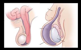 Image result for Inguinal hernia child
