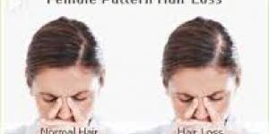 After menopause, many different physical symptoms can appear, including menopausal hair loss. Is Hair Loss A Symptom Of Menopause Hormone Changes At Perimenopause Can Cause Some Women To Experience Hair Thinning Or Hair Loss My Second Spring