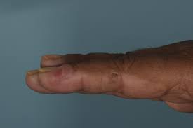 The Case Bullous Eruptions In End Stage Renal Failure Kidney International
