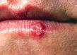 Herpes simplex type 1