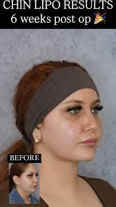 new jawline, who dis? 🥱, chin lipo results ONLY 6 weeks POST OP 🎉,  #chinlipo #chinliposuction #doublechin #doublechinremoval #sagarsnatched