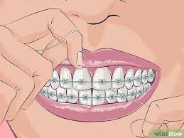 We did not find results for: 3 Ways To Deal With Braces Wikihow