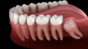 Dentista em Santos explica sobre Remoção de dentes do siso