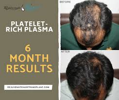 Doctors use a small needle to inject prp into your scalp, hoping to stimulate hair follicles and create new hair growth. Prp Treatment Results After 6 Months Rejuvenate Hair