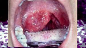 Make sure to ask your health care provider about the best screening schedule for you. Hpv Causing Surge In Oral Cancer Rates Ctv News