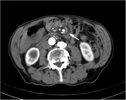Image result for Midgut Volvulus