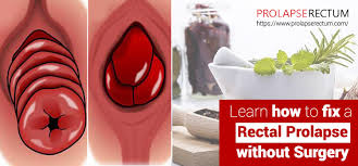As the condition worsens, the prolapse needs to be manually dealt with or will not recede at all. How To Fix A Rectal Prolapse Without Surgery