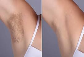 Axillary hair was removed by shaving, plucking or waxing. 9 Effective Ways To Remove Underarm Armpit Hair