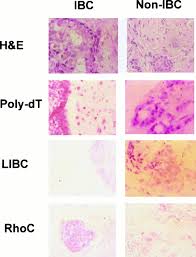 What makes a breast cancer an inflammatory breast cancer is the presence of cancer cells in the skin. A Novel Putative Low Affinity Insulin Like Growth Factor Binding Protein Libc Lost In Inflammatory Breast Cancer And Rhoc Gtpase Correlate With The Inflammatory Breast Cancer Phenotype Clinical Cancer Research