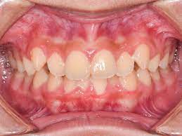 How is oral cancer typically diagnosed? On The Lookout For Oral Cancer
