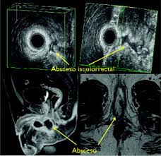 Thrombosed hemorrhoids occur when either an internal or external hemorrhoid. Urgencias Proctologicas Sciencedirect