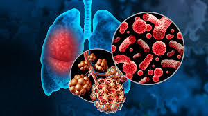 Image result for Pneumonia