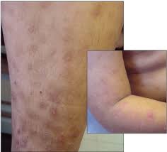 Image result for Papular urticaria