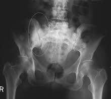 09.03.2021 · prostate cancer is one of the types of cancer that is most likely to spread, or metastasize, to bones. Bone Metastasis Wikipedia
