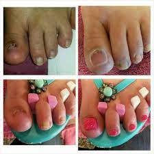 Acrylic Toe Nail Reconstruction Nogti