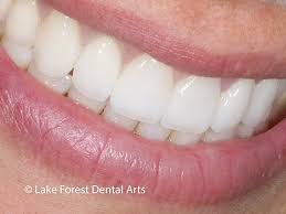 We did not find results for: Porcelain Bridge Before And After Pictures Bridges With No Metal