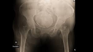 It can be hard to detect, but can be treated. Fda Approves Avastin Ovarian Cancer L Pharma Intelligence