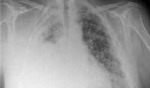 This scan is limited, but may be able to detect damage or abnormalities in the body. Asbestos Cancer Screenings Can Be Scary But Are Necessary