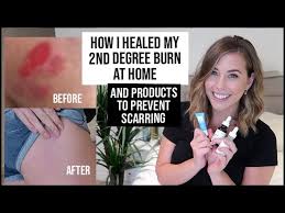 How long does it usually take for a burn to heal? How I Healed My Burn Scar Prevent A Burn From Scarring Xameliax Youtube