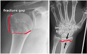 Maybe you would like to learn more about one of these? Fracture General Principles Startradiology