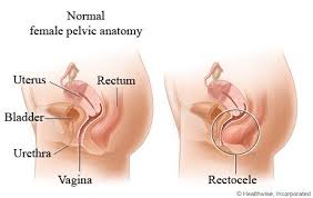 Trihealth Associates In Ob Gyn Trihealth Bladder Prolapse Pelvic Organ Prolapse Bladder